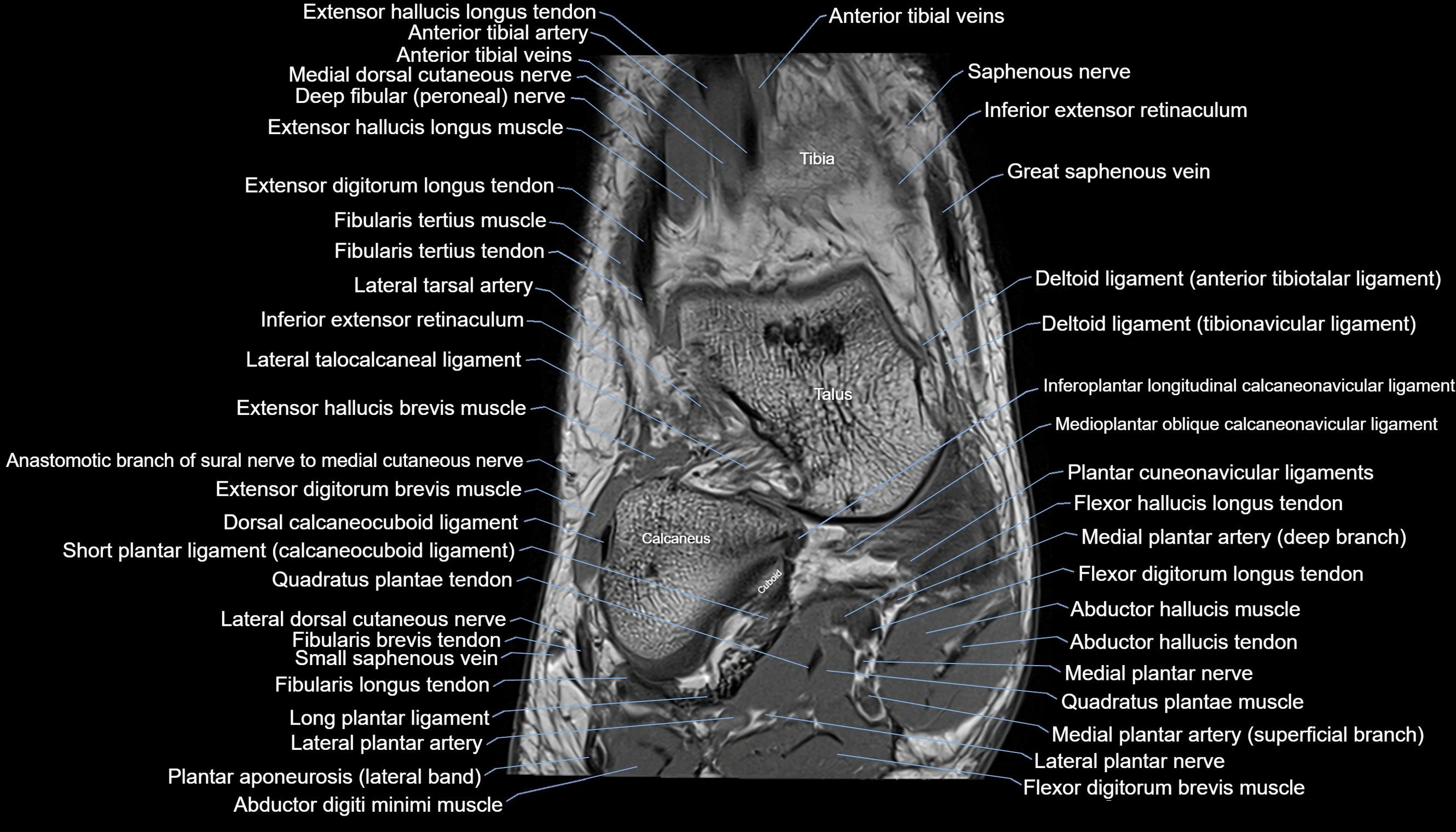 Ankle coronal anatomy 3T MRI images -img-11001-00005.webp